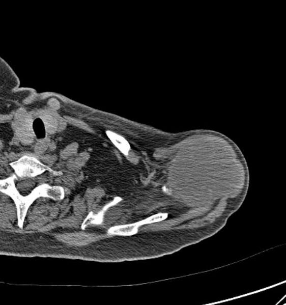 File:Clear cell chondrosarcoma - humerus (Radiopaedia 63104-71612 Axial non-contrast 19).jpg