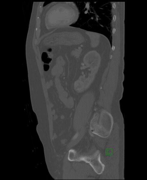 File:Clear cell renal cell carcinoma (Radiopaedia 85006-100539 Sagittal bone window 19).jpg