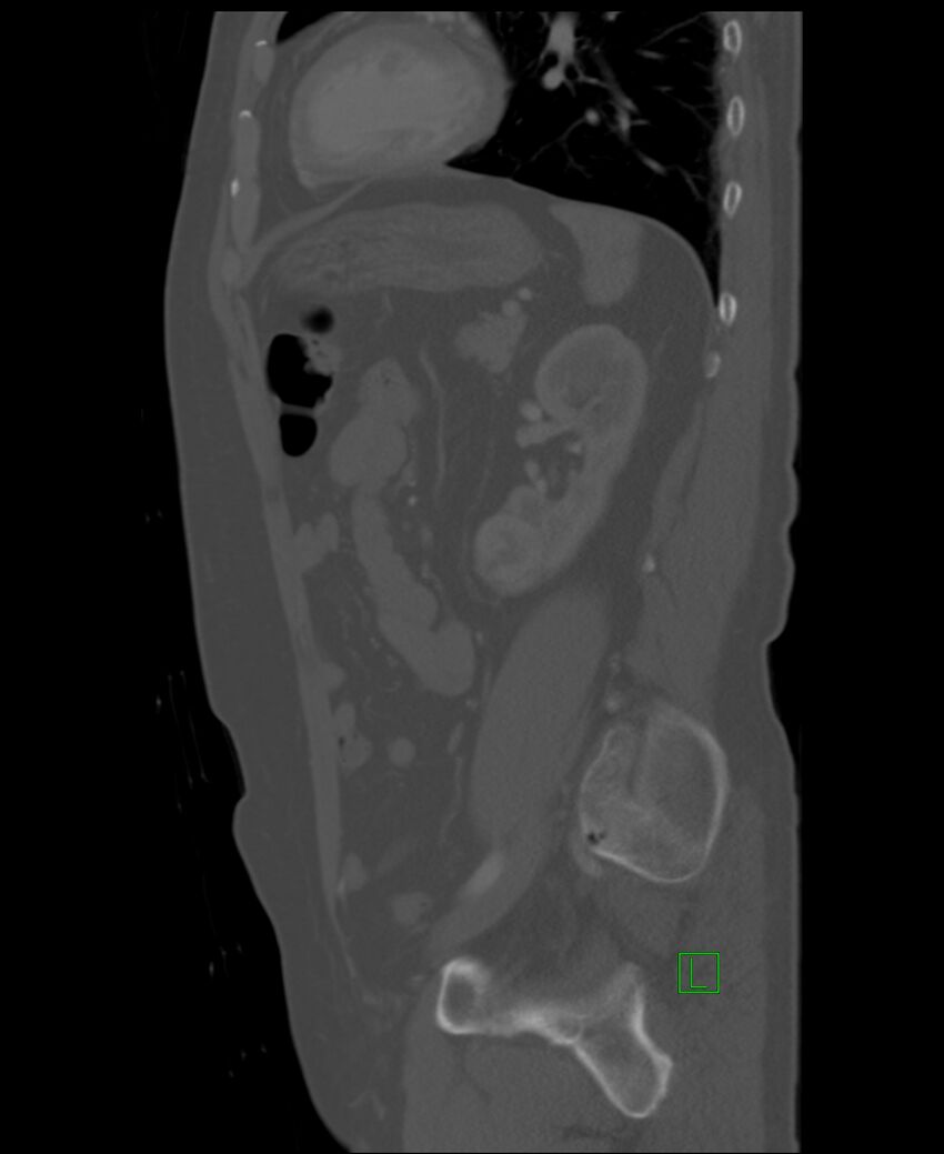 Clear cell renal cell carcinoma (Radiopaedia 85006-100539 Sagittal bone window 19).jpg