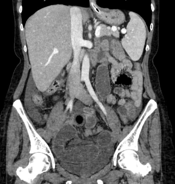 File:Closed loop small bowel obstruction (Radiopaedia 71211-81508 B 59).jpg