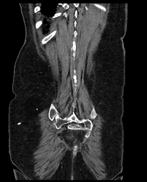 File:Closed loop small bowel obstruction - adhesions (Radiopaedia 59269-66611 B 113).jpg