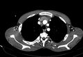 Coarctation of aorta with aortic valve stenosis (Radiopaedia 70463-80574 A 21).jpg