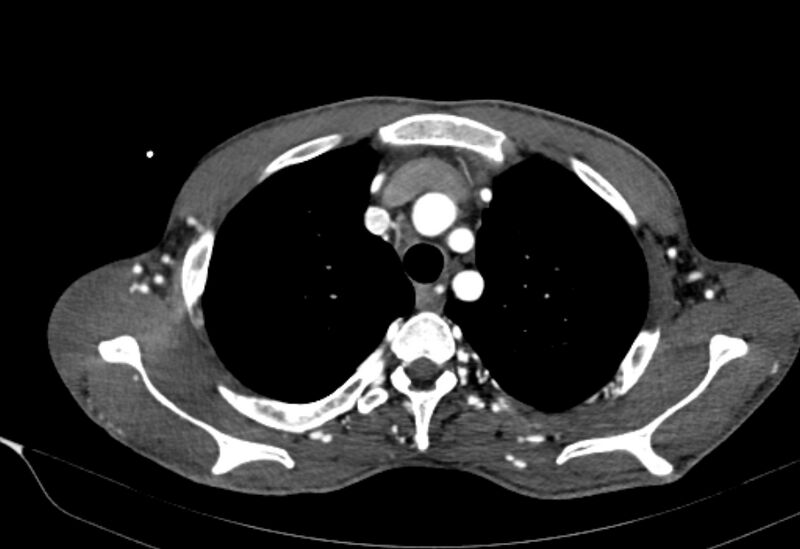 File:Coarctation of aorta with aortic valve stenosis (Radiopaedia 70463-80574 A 21).jpg