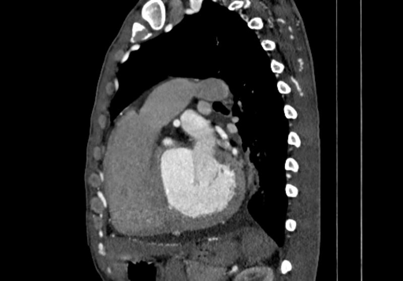 File:Coarctation of aorta with aortic valve stenosis (Radiopaedia 70463-80574 B 105).jpg