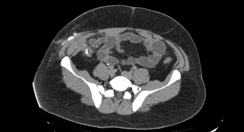 File:Colocutaneous fistula (Radiopaedia 56401-63062 Axial Fistulography 30).jpg