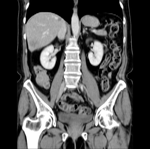 File:Colon carcinoma with hepatic metastases (Radiopaedia 29477-29961 B 25).jpg