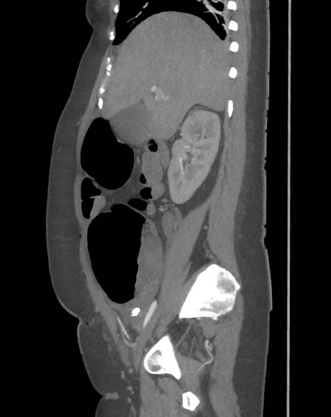 File:Colonic pseudo-obstruction (Radiopaedia 79752-92980 C 28).png