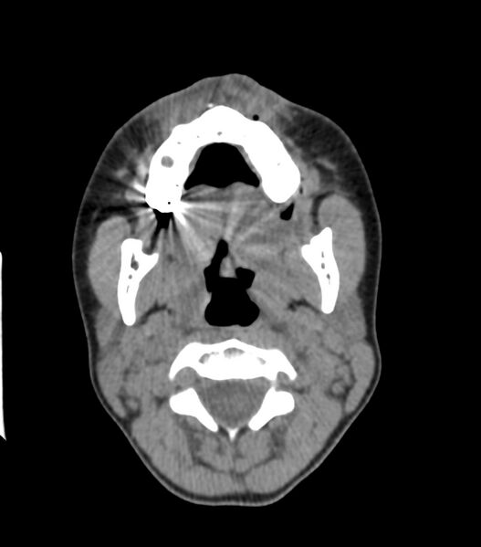 File:Nasoorbitoethmoid fracture (Radiopaedia 90044-107205 Axial non-contrast 88).jpg