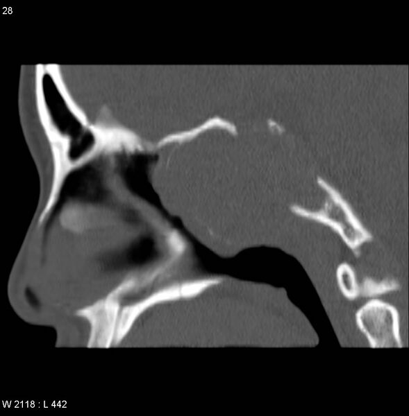 File:Nasopharyngeal carcinoma (recurrent) (Radiopaedia 5061-6903 Sagittal bone window 1).jpg
