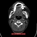 Nasopharyngeal carcinoma recurrence - skull base destruction (Radiopaedia 29107-29491 A 19).jpg