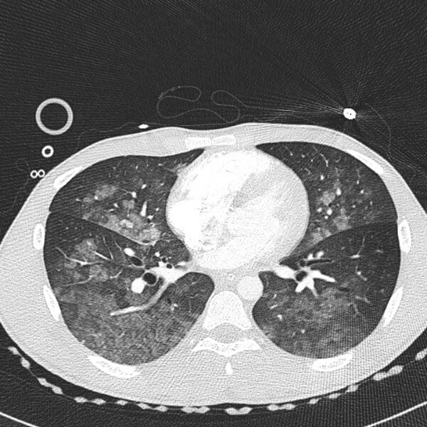 File:Near drowning (pulmonary edema) (Radiopaedia 24685-24958 lung window 41).jpg