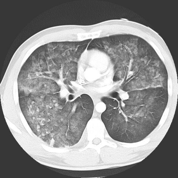 File:Near drowning pulmonary edema (Radiopaedia 16868-16591 Axial lung window 23).jpg