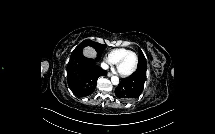 Neo-terminal ileal stricture (Crohn disease) (Radiopaedia 33790-34948 A 8).jpg