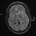 Neurotoxoplasmosis - concentric target sign (Radiopaedia 70644-80784 Axial FLAIR 11).jpg