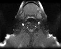 Non-Hodgkin lymphoma - parotid gland (Radiopaedia 71531-81890 T1 fat sat 4).jpg