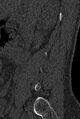Normal CT lumbar spine (Radiopaedia 53981-60118 Sagittal bone window 7).jpg