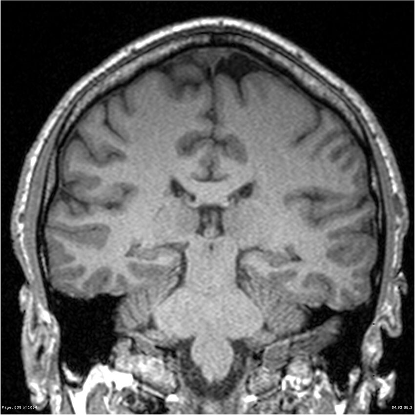 Normal brain MRI (non-focal epilepsy protocol) (Radiopaedia 38571-40700 Coronal T1 45).jpg