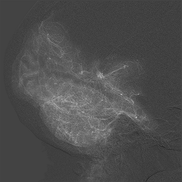 File:Normal cerebral angiogram (four vessel DSA) (Radiopaedia 41708-44649 L 15).png