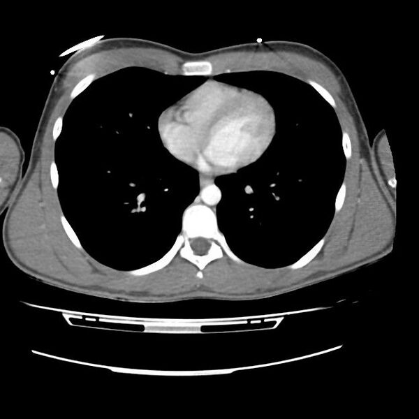 File:Normal dual-phase trauma CT chest,abdomen and pelvis (Radiopaedia 48092-52899 A 35).jpg