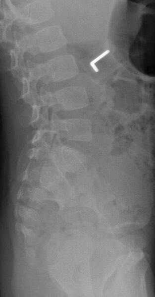 File:Normal lateral lumbar spine radiograph - infant (Radiopaedia 46693).jpg