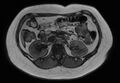 Normal liver MRI with Gadolinium (Radiopaedia 58913-66163 B 13).jpg