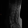 Normal spine MRI (Radiopaedia 77323-89408 Sagittal T1 7).jpg