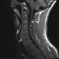 Normal trauma cervical spine (Radiopaedia 41017-43762 Sagittal T1 6).png