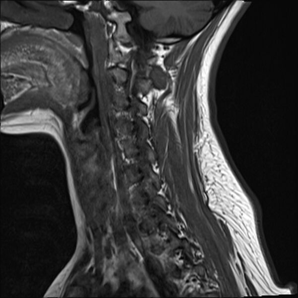 File:Normal trauma cervical spine MRI (Radiopaedia 32130-33071 Sagittal T1 4).jpg