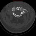 Occipital condyle fracture (Radiopaedia 18366-18208 Axial bone window 19).jpg