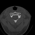 Occipital condyle fracture (Radiopaedia 31755-32691 Axial bone window 21).jpg