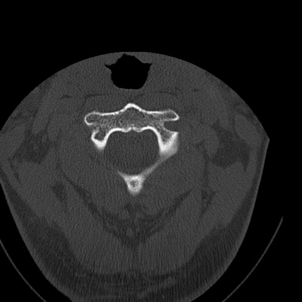 File:Occipital condyle fracture (Radiopaedia 31755-32691 Axial bone window 21).jpg