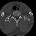 Occipital condyle fracture (Radiopaedia 31755-32691 Axial bone window 81).jpg