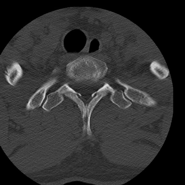 File:Occipital condyle fracture (Radiopaedia 31755-32691 Axial bone window 81).jpg