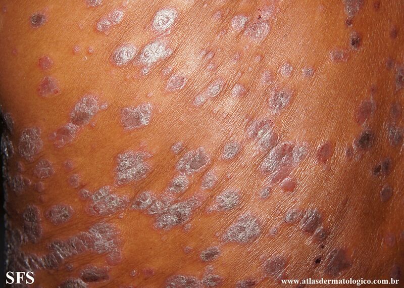 File:Psoriasis (Dermatology Atlas 141).jpg