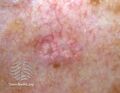 Sebaceous hyperplasia dermoscopy (DermNet NZ TAUR15031).jpg