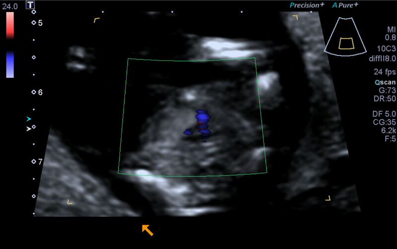 File:1st trimester nuchal-morphology ultrasound (Radiopaedia 44706-48477 Heart views cine with colour 147).jpg