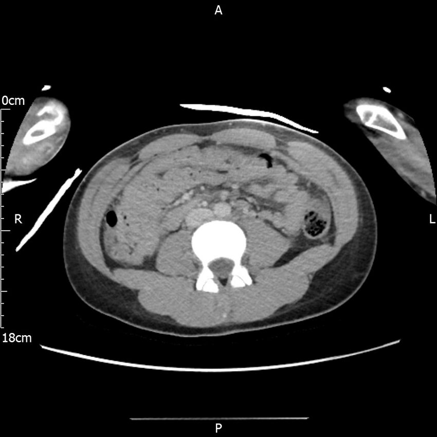AAST grade IV kidney injury with CEUS follow-up (Radiopaedia 72353-82877 Axial C+ portal venous phase 39).jpg