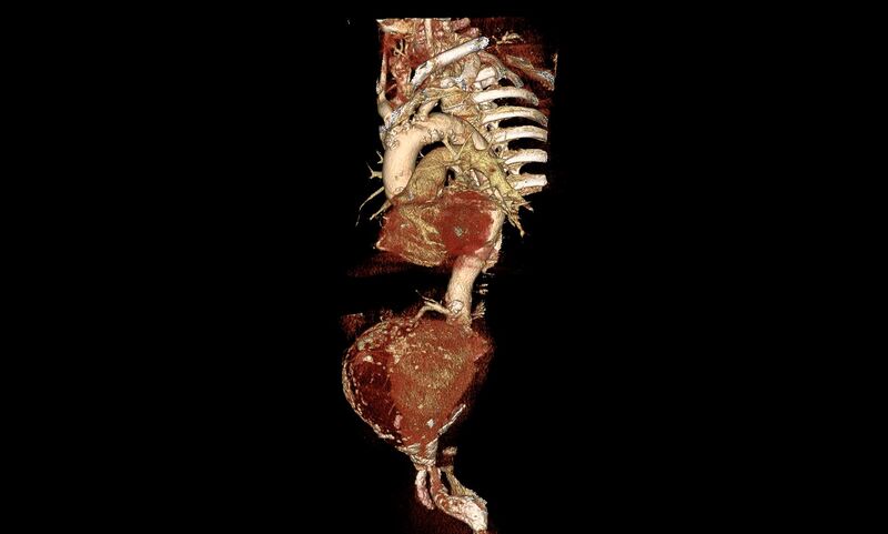 File:Abdominal aortic aneurysm- extremely large, ruptured (Radiopaedia 19882-19921 3D 5).jpg
