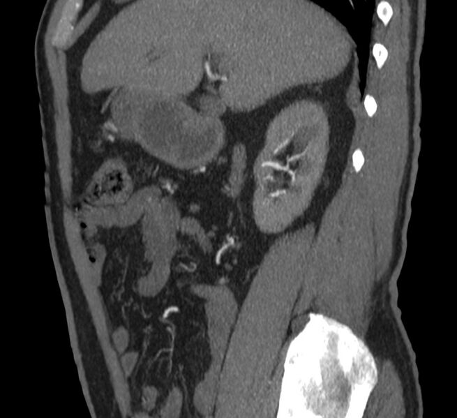 File:Abdominal aortic aneurysm (Radiopaedia 22421-22458 D 8).jpg