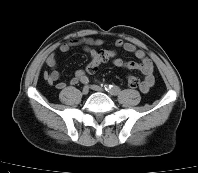 File:Abdominal aortic aneurysm (Radiopaedia 22421-22458 non-contrast 38).jpg