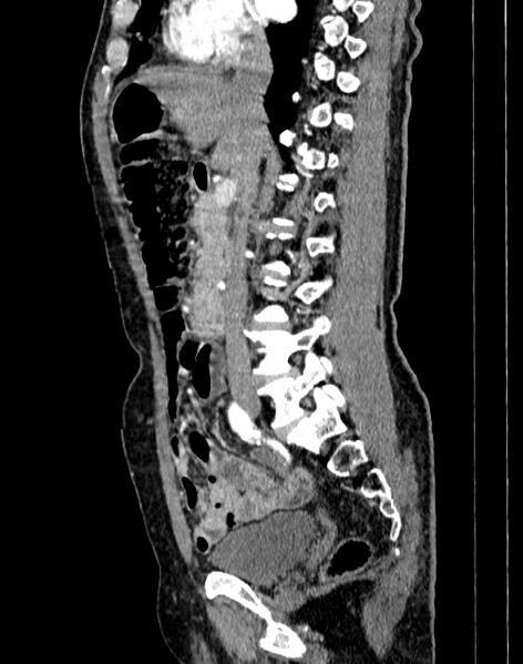File:Abdominal aortic aneurysm (Radiopaedia 83581-98689 Sagittal C+ arterial phase 28).jpg