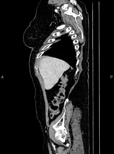 File:Abdominal aortic aneurysm (Radiopaedia 85063-100606 Sagittal C+ arterial phase 10).jpg