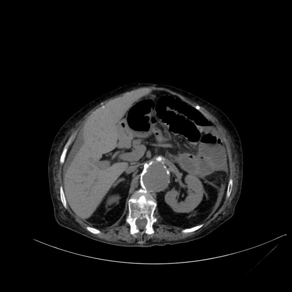 File:Abdominal aortic aneurysm - impending rupture (Radiopaedia 19233-19246 Axial non-contrast 43).jpg