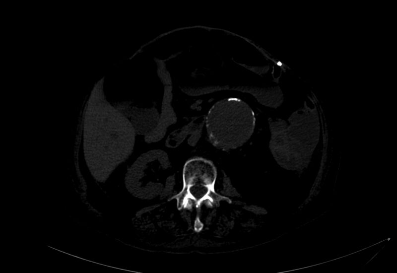 File:Abdominal aortic aneurysm - impending rupture (Radiopaedia 19233-19246 B 12).jpg