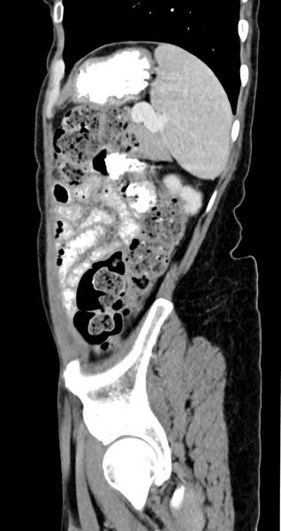 File:Abdominal wall and retroperitoneal tuberculosis (Radiopaedia 88137-104729 Sagittal C+ portal venous phase 35).jpg
