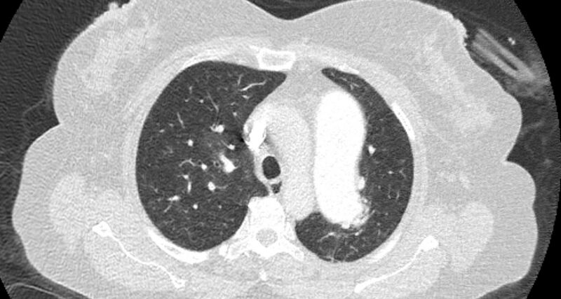 File:Accessory right inferior hepatic vein (Radiopaedia 65245-74259 Axial lung window 17).jpg
