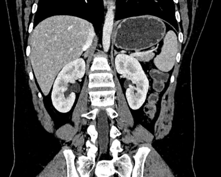 File:Accessory right inferior hepatic vein (Radiopaedia 75207-86305 Coronal C+ portal venous phase 45).jpg