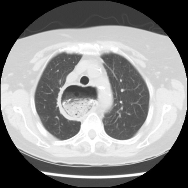 File:Achalasia (Radiopaedia 44094-47649 Axial lung window 15).jpg