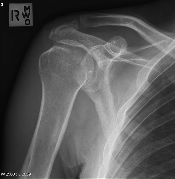 File:Acromion fracture (Radiopaedia 12284-12581 C 1).jpg