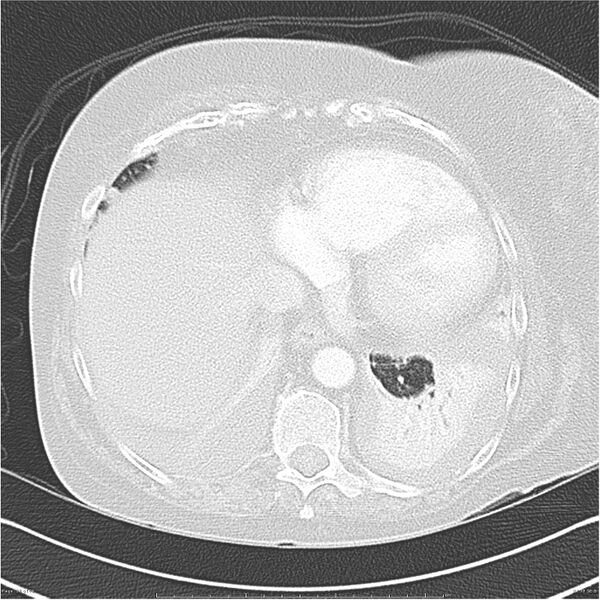 File:Acute-on-chronic pulmonary emboli (Radiopaedia 27925-28169 lung window 38).jpg
